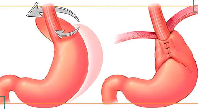 Funduplicatura: Cirugía para Reflujo Gastroesofágico