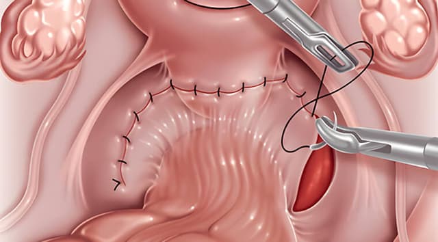Reparación de prolapso rectal