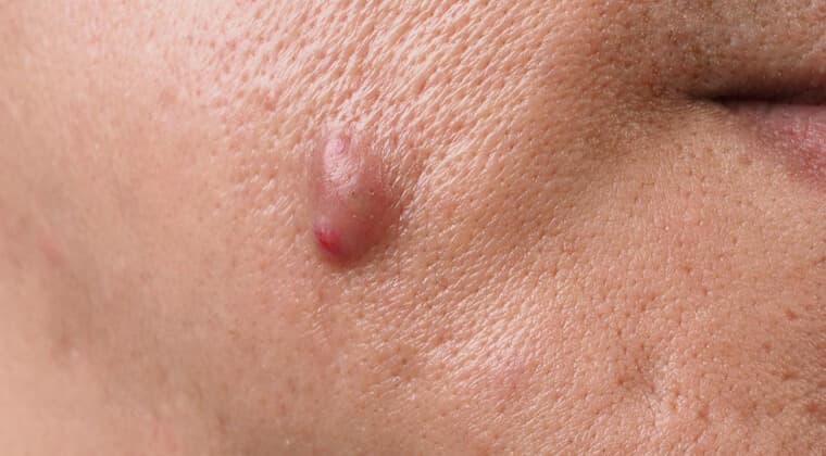 Abscesos