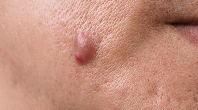 Abscesos