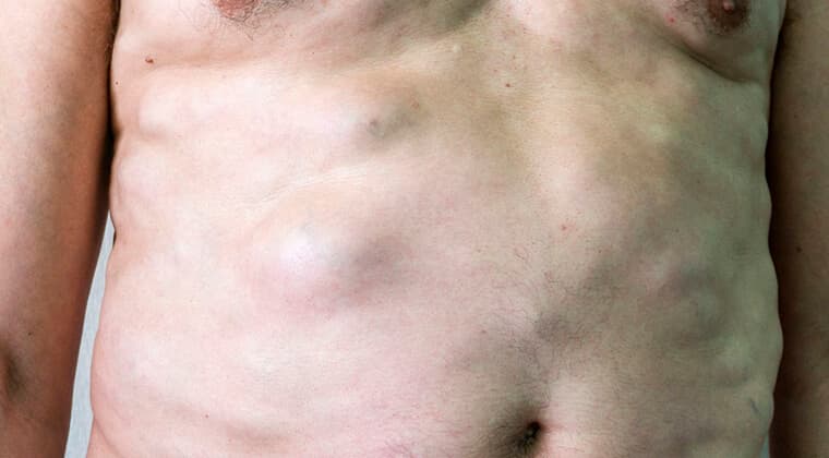Masa o bulto en alguna parte del cuerpo