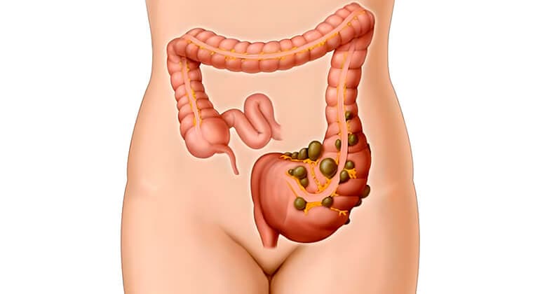Enfermedad diverticular del colon