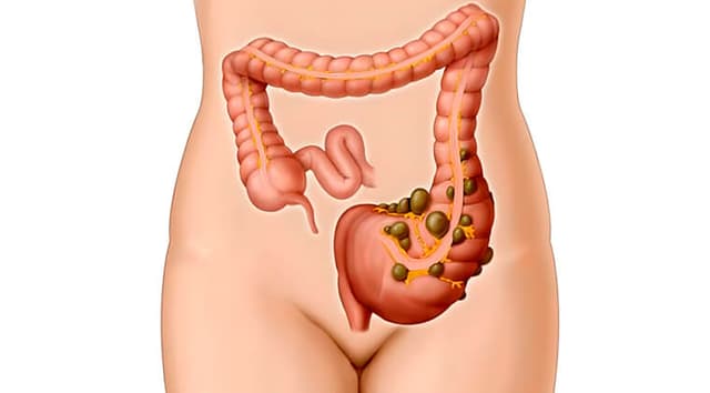 Enfermedad diverticular del colon