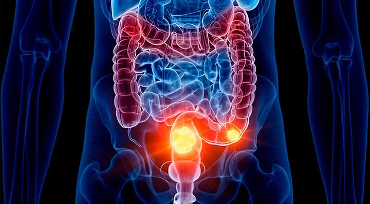 Obstrucción intestinal