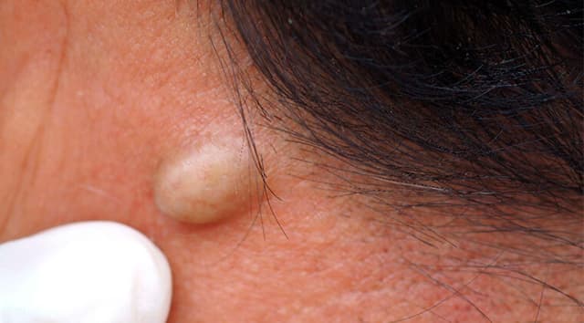 Quistes sebáceos o lipomas