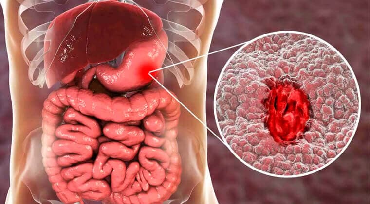 Úlcera gástrica perforada